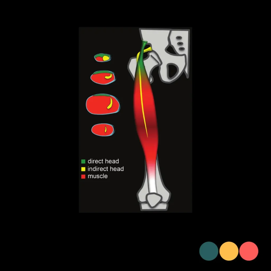 Rectus femoris normale anatomie