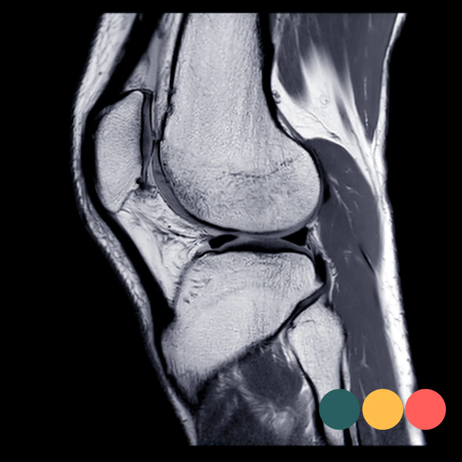 Anterior cruciate ligament injury
